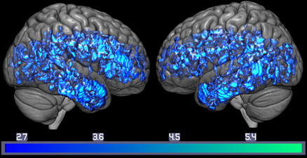 serotonin-alzheimers