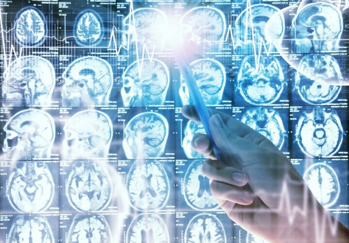 brain scan alzheimers
