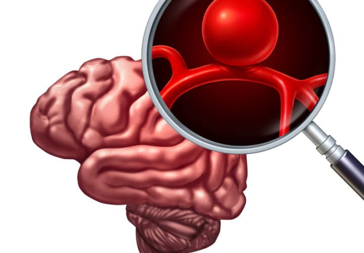 Brain Aneurysm