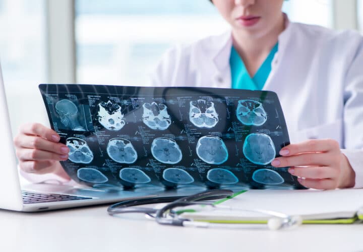 alzheimer's drug