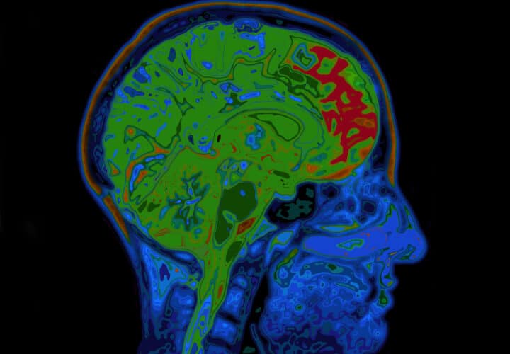 stroke dementia