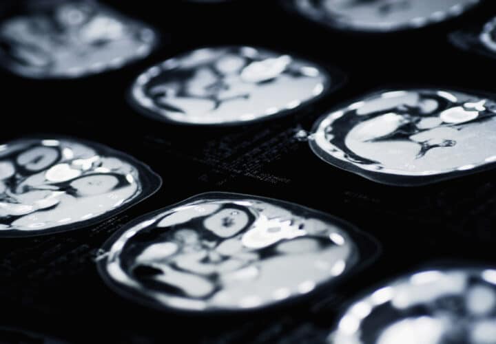 clinical trial for alzheimers