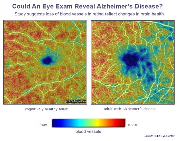 alzheimers-eye-test