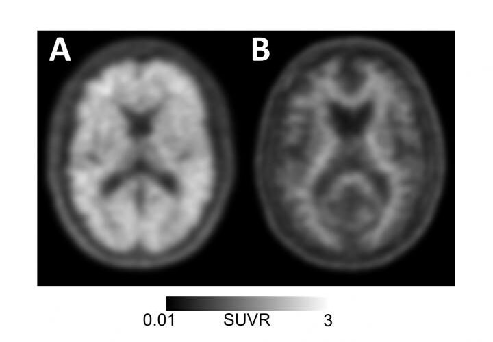 amyloid-pet-scan