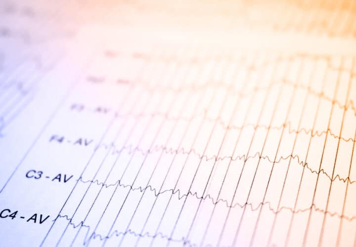 electrical stimulation alzheimers