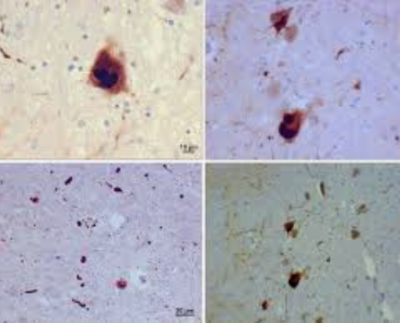 Lewy body dementia
