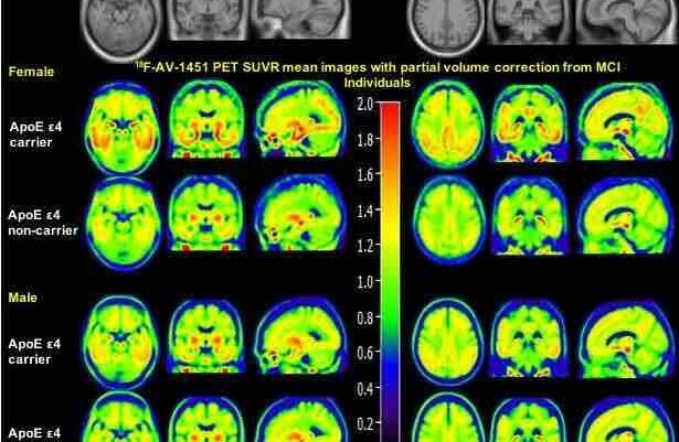 brain scans of tau tangles in alzheimer's