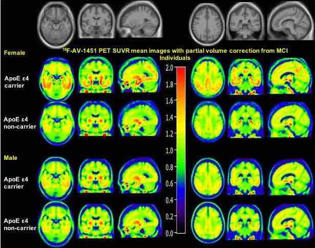 brain scans of tau tangles in alzheimer's