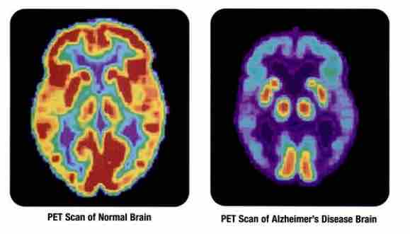 pet scan of brain with alzheimer's