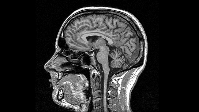 speech-loss-from-dementia-aphasia