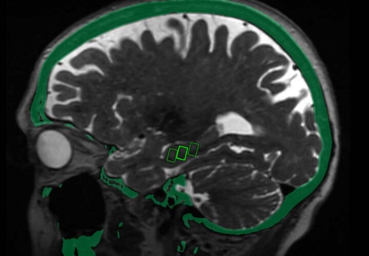 ultrasound alzheimers genetic variant