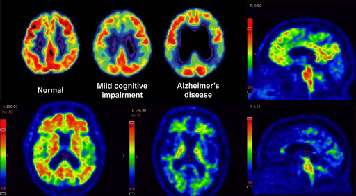 incorrect alzheimer's diagnosis