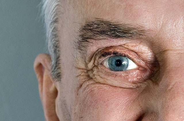 Alzheimer’s Biomarker in the eye