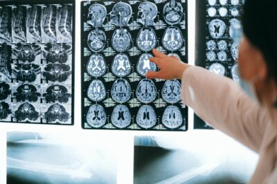 Aduhelm aducanumab Alzheimer's drug donanemab explainer donanemab lecanemab