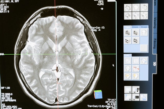 brain white matter, gray matter, TBI and alzheimer's