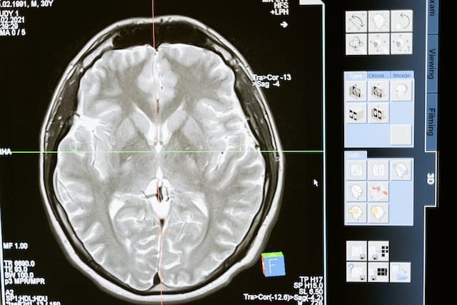 alzheimers drug remternetug trials